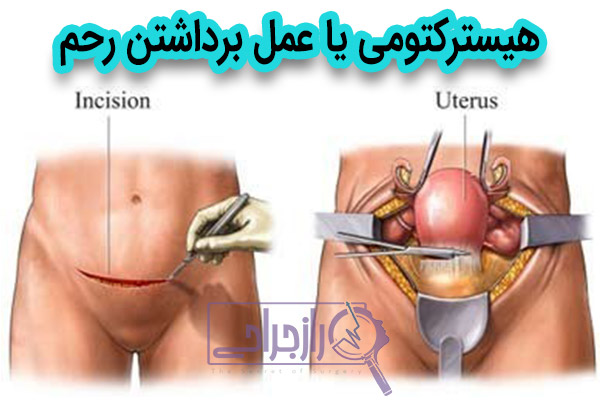 هیسترکتومی - راز جراحی