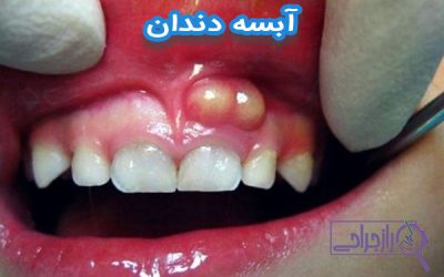 آبسه دندان