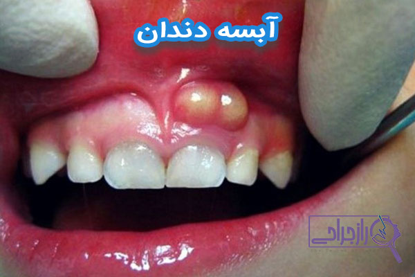 آبسه دندان - راز جراحی