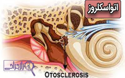 اتواسکلروز