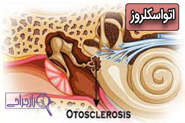 اتواسکلروز - راز جراحی