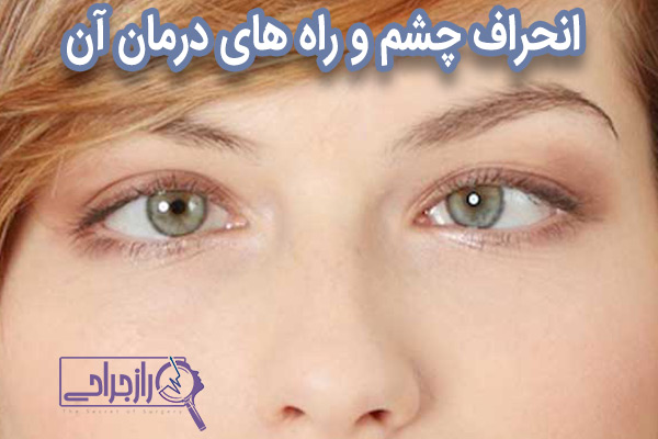 انحراف چشم - راز جراحی