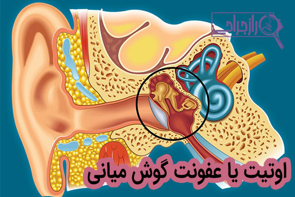 اوتیت - راز جراحی