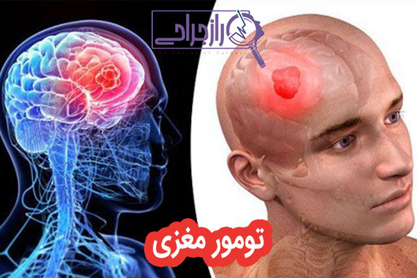 تومور مغزی - راز جراحی