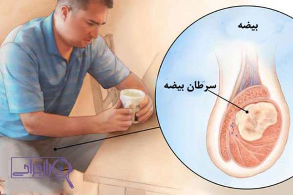 سرطان بیضه - راز جراحی