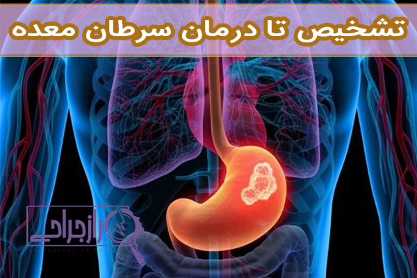 سرطان معده - راز جراحی