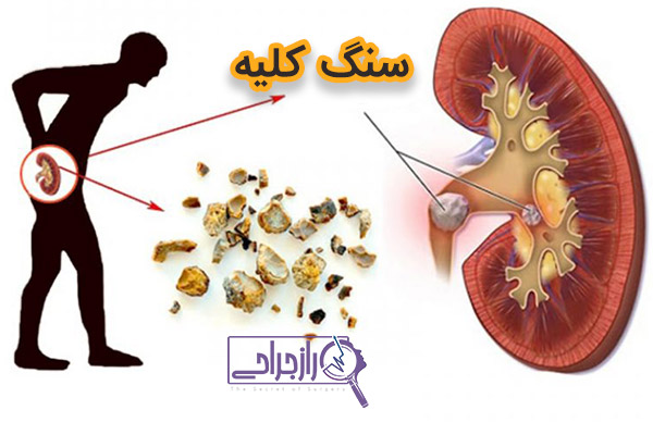 سنگ کلیه - راز جراحی