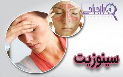 سینوزیت