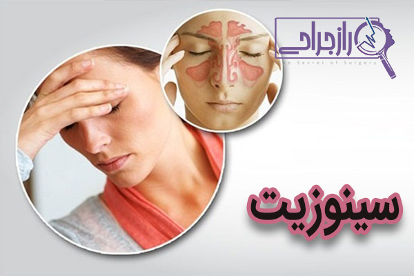 سینوزیت - راز جراحی