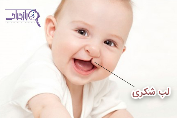 لب شکری - راز جراحی