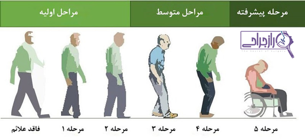 مراحل بیماری پارکینسون - راز جراحی
