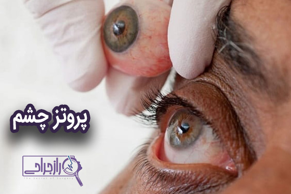 پروتز چشم - راز جراحی