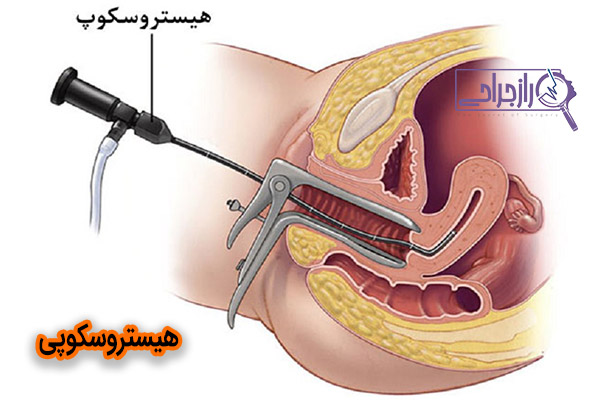 هیستروسکوپی - راز جراحی