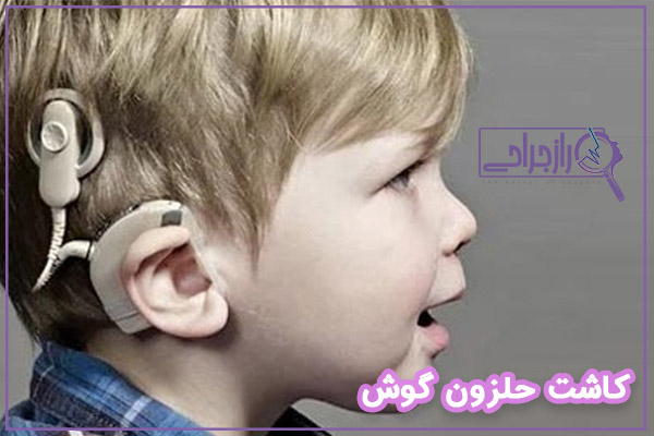 کاشت حلزون - راز جراحی