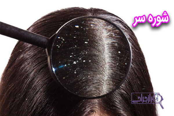شوره سر - راز جراحی