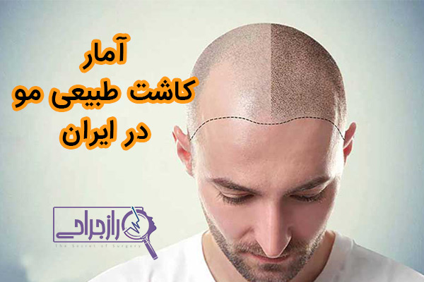 آمار کاشت طبیعی مو در ایران - راز جراحی