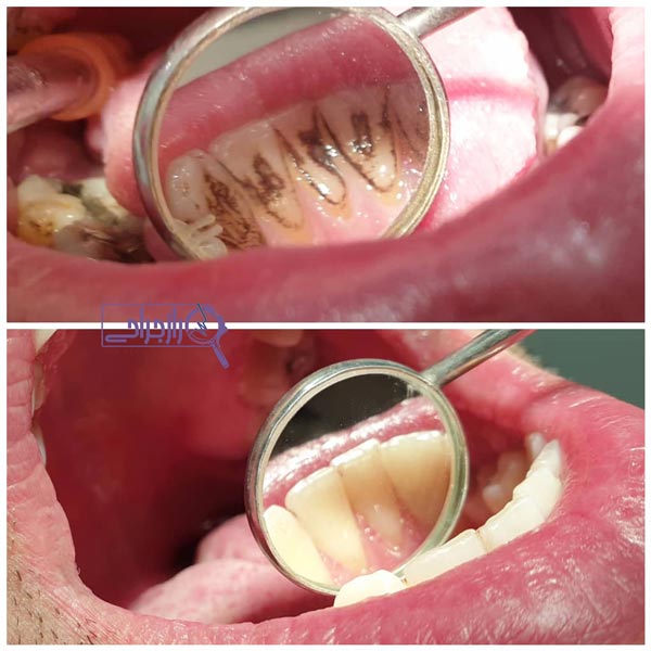 جرم گیری دندان - راز جراحی