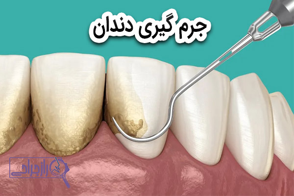 جرم گیری دندان - راز جراحی