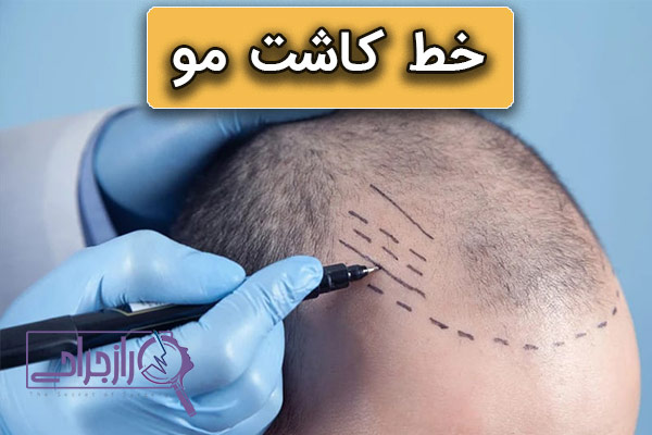 خط کاشت مو - راز جراحی