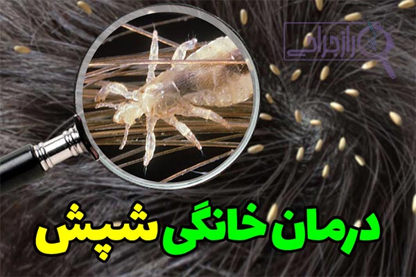 درمان خانگی شپش سر - راز جراحی
