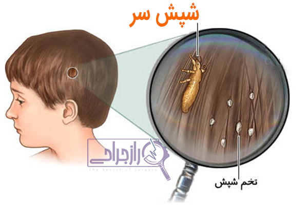 شپش سر - راز جراحی