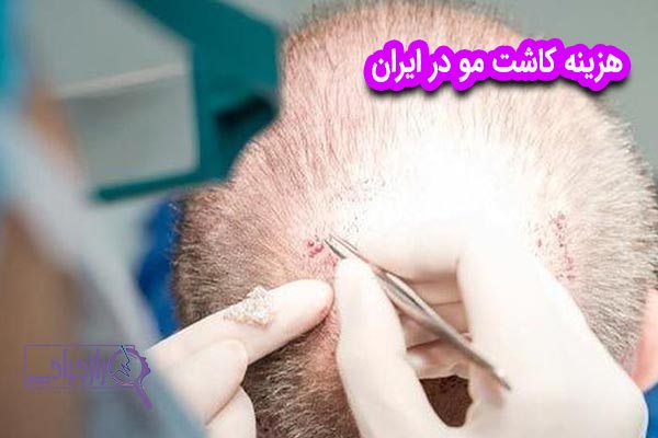 هزینه کاشت مو در ایران - راز جراحی