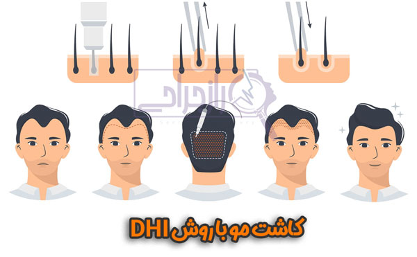 کاشت مو با روش DHI - راز جراحی