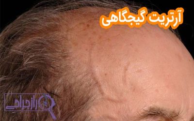 آرتریت گیجگاهی