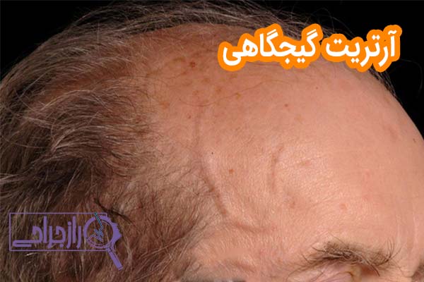 آرتریت گیجگاهی - راز جراحی