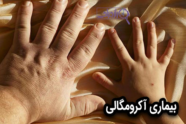 آکرومگالی - راز جراحی