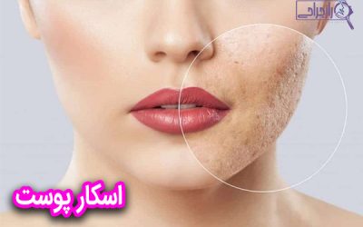 اسکار پوست