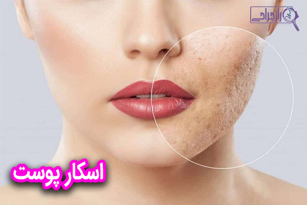 اسکار پوست - راز جراحی