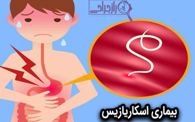 اسکاریازیس