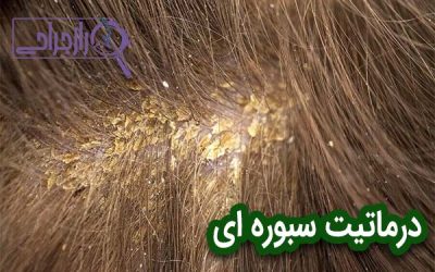 درماتیت سبوره ای