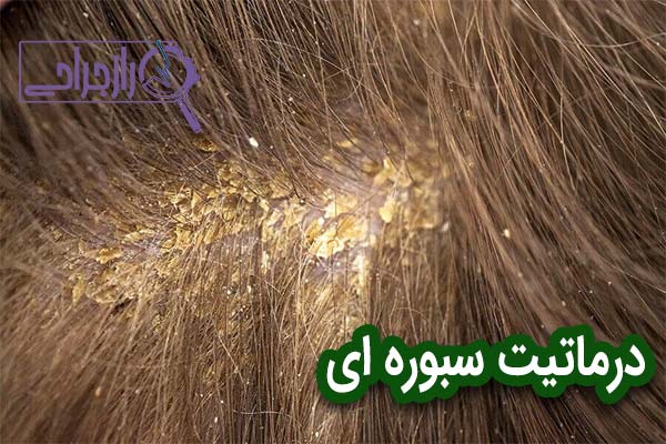 درماتیت سبوره ای - راز جراحی