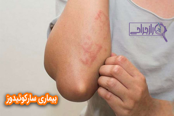 سارکوئیدوز - راز جراحی