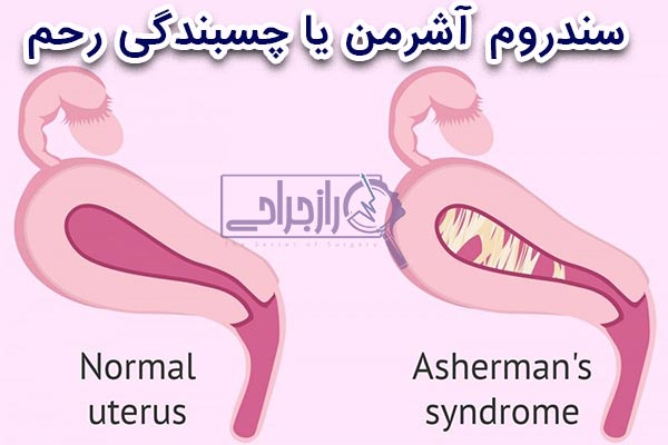 سندروم آشرمن - راز جراحی