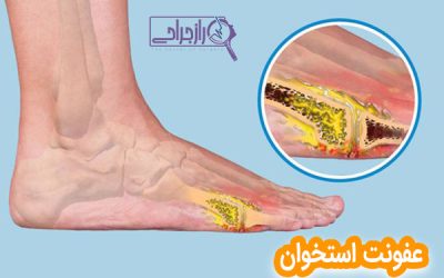 عفونت استخوان