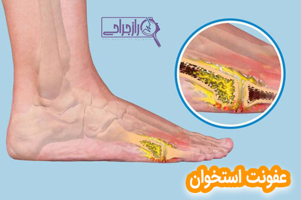 عفونت استخوان - راز جراحی