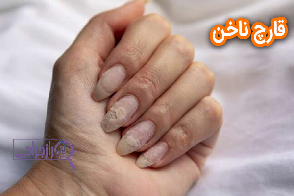 قارچ ناخن - راز جراحی