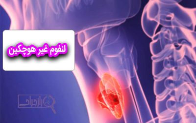 لنفوم غیر هوچکین