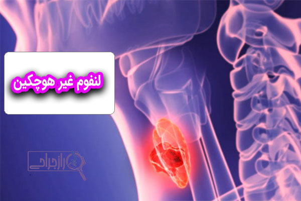 لنفوم غیر هوچکین - راز جراحی