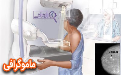 ماموگرافی صفر تا صد + راز جراحی