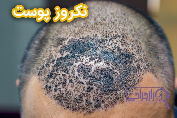 نکروز پوست - راز جراحی