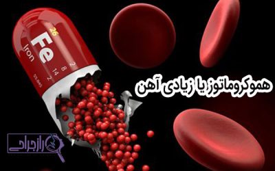 هموکروماتوز