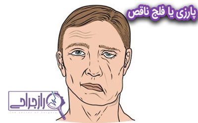 پارزی یا فلج ناقص