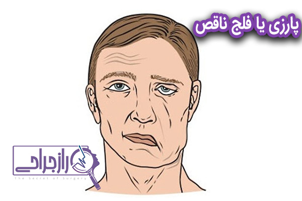 پارزی - راز جراحی