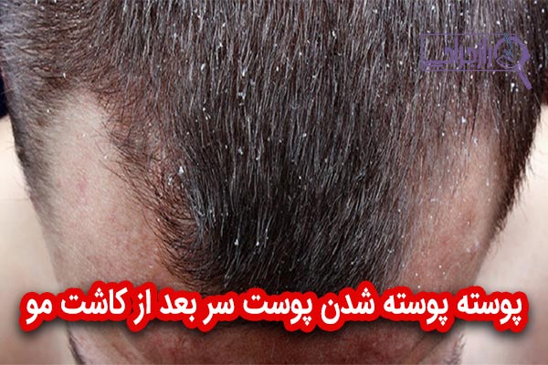 پوسته پوسته شدن پوست سر بعد از کاشت مو - راز جراحی