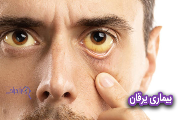 یرقان - راز جراحی