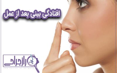 افتادگی بینی بعد از عمل